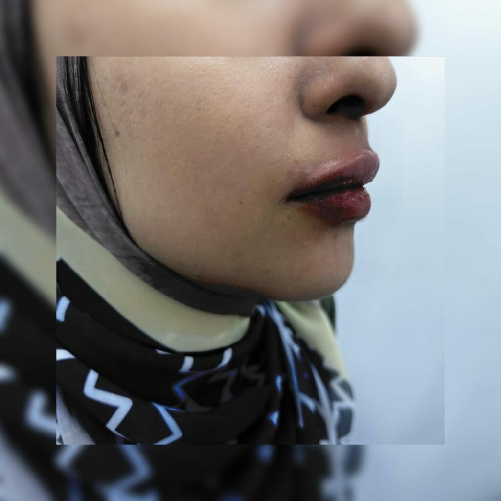 حقن الهيالورونيك للشفايف للتكبير والتفتيح